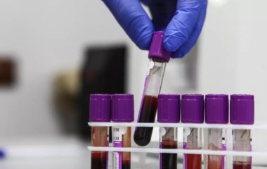 Онколог розповів, як гарячий душ допомагає виявити рак крові.