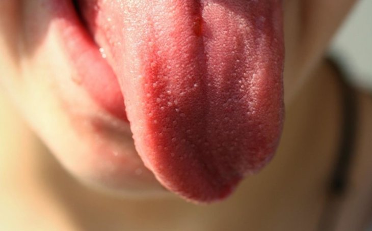 Налет на языке: что он может рассказать о вашем здоровье