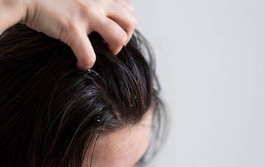 Як боротися з перхоттю: все, що потрібно знати