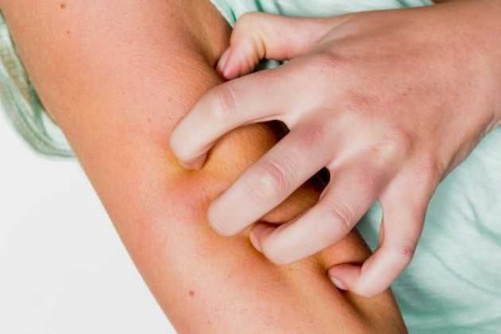 Укуси комах: як надати першу допомогу і коли звертатися до лікаря