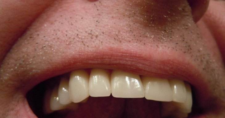 Топ продуктів, які руйнують зуби — і це не солодощі